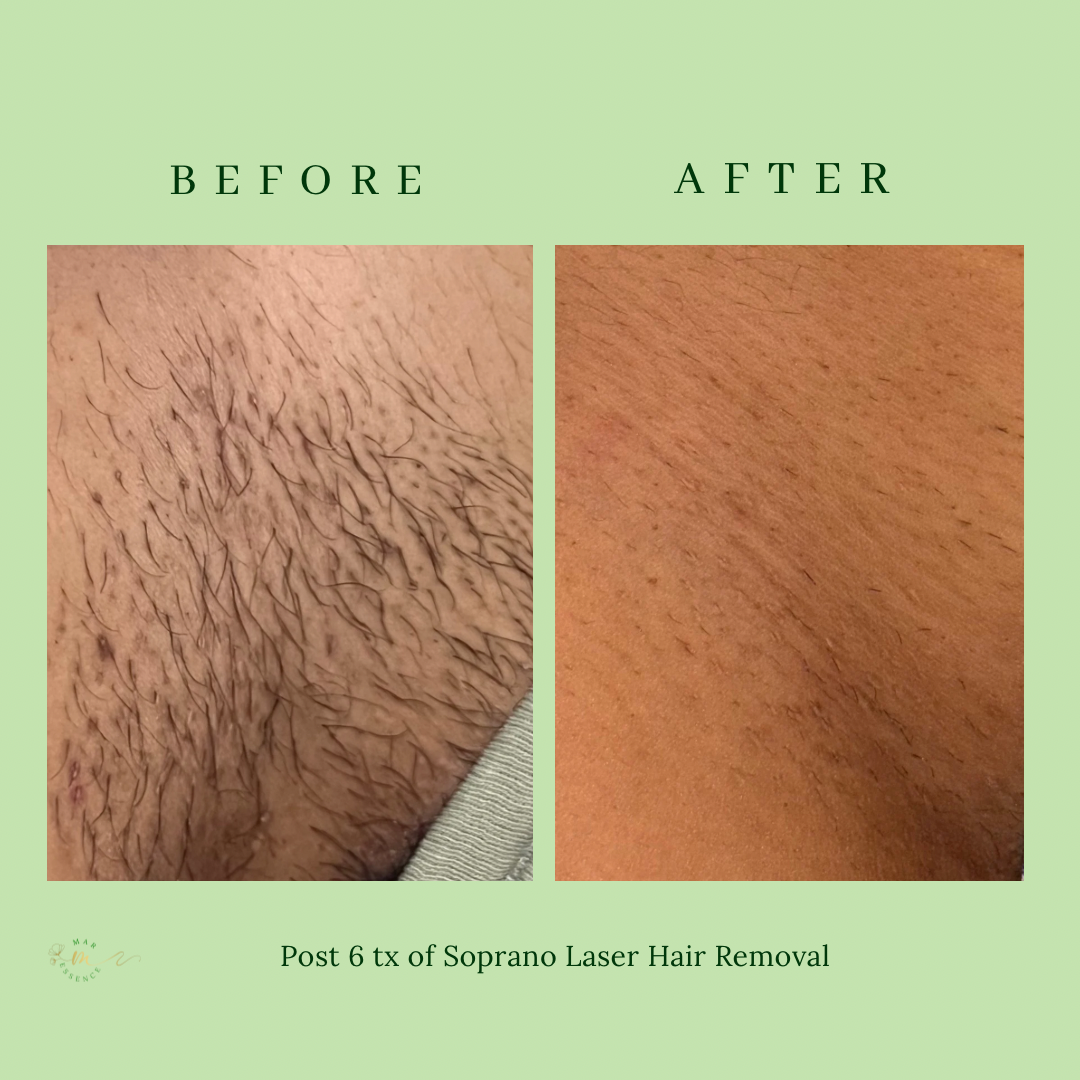 What Is Laser Hair Removal?